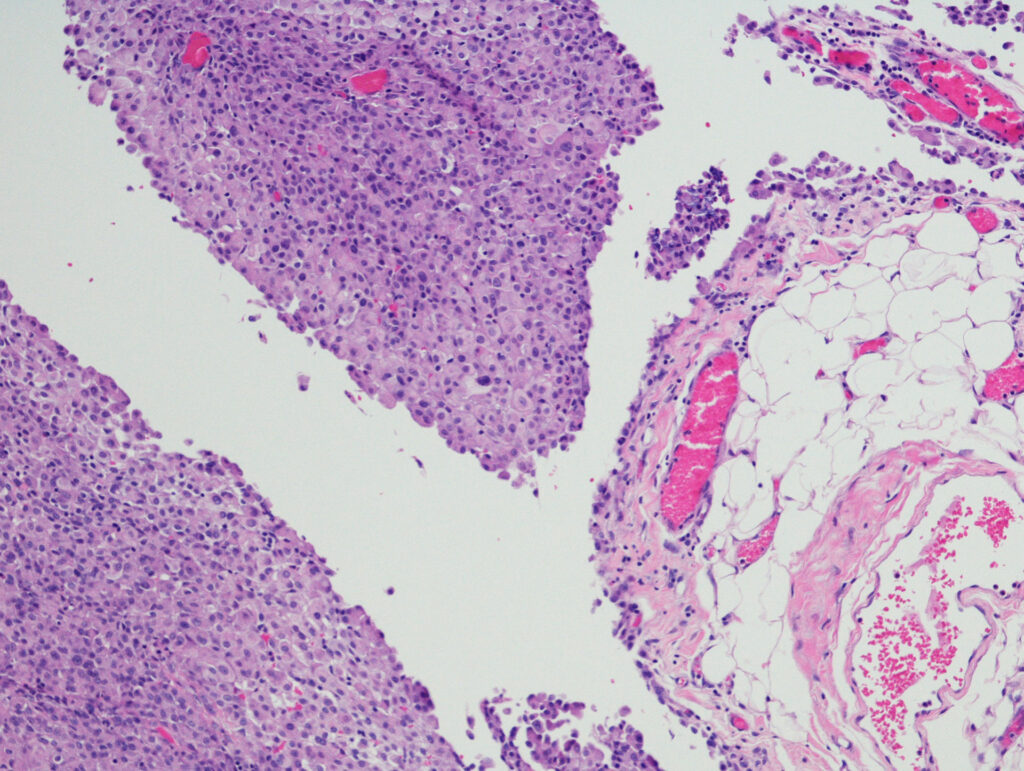 peritoneal meso