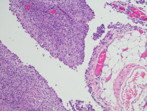 peritoneal meso