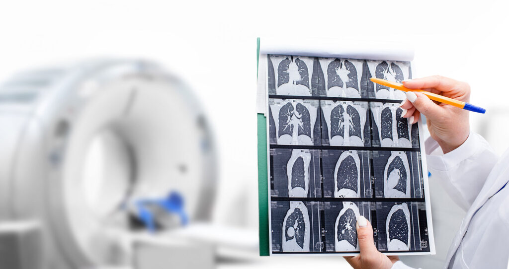 asbestos and lung cancer