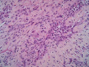 mesothelioma