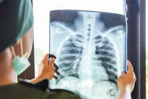 How Long Does It Take Asbestos Lung Cancer to Develop