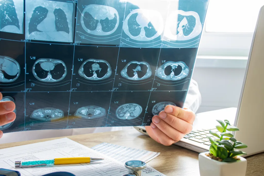 Diagnosis of Asbestosis