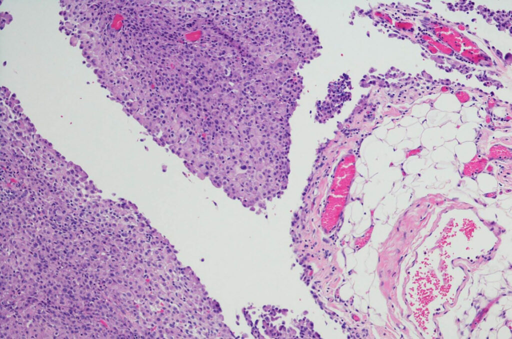 mesothelioma