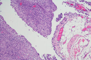 mesothelioma